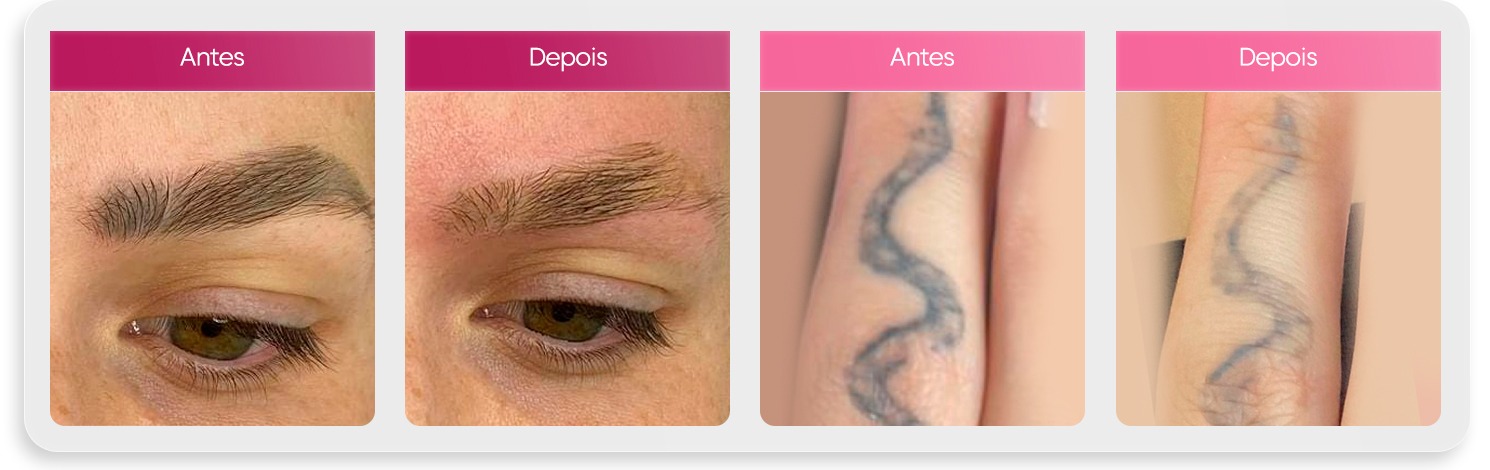 resultados antes e depois croma beauty 