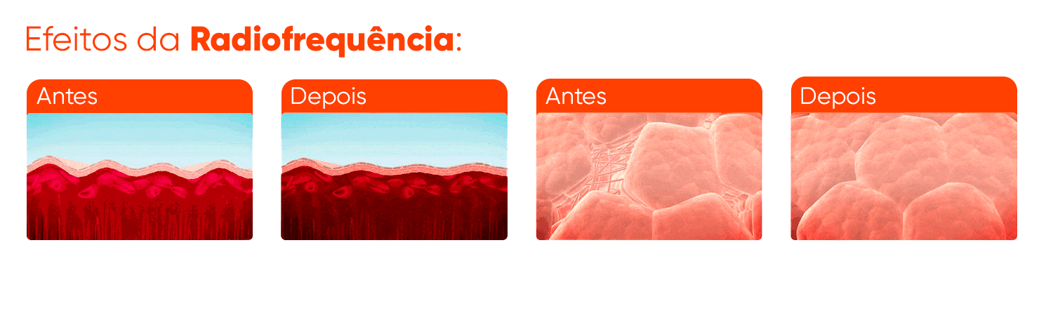 efeitos da radiofrequência com o hertix smart