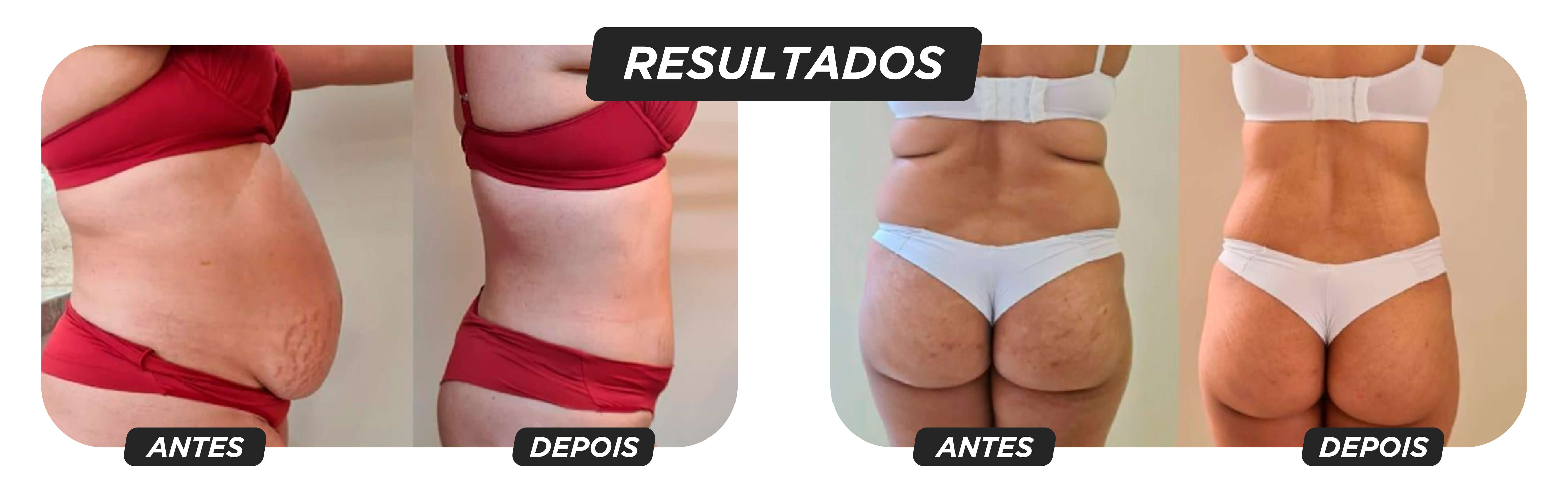 criodermis 2.0 aparelho de criolipolise de placas medical san antes e depois